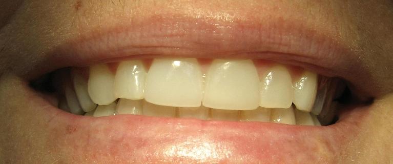 Teeth-Whitening-Porcelain-Veneers-After-Image