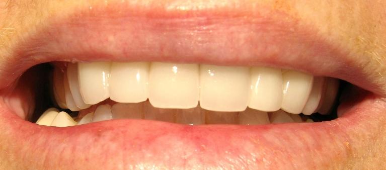 Metal-Free-Crowns-Porcelain-Veneers-After-Image