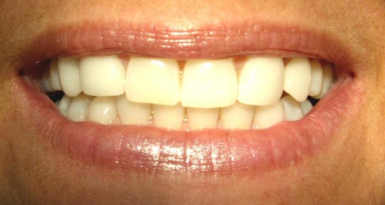 In-Office-Teeth-Whitening-Porcelain-Veneers-After-Image