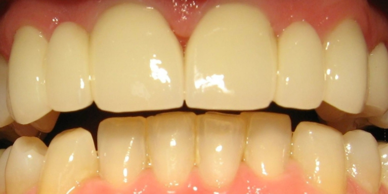 Metal-Free-Bridges-After-Image