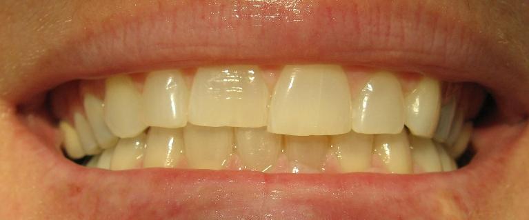 Teeth-Whitening-Porcelain-Veneers-Before-Image