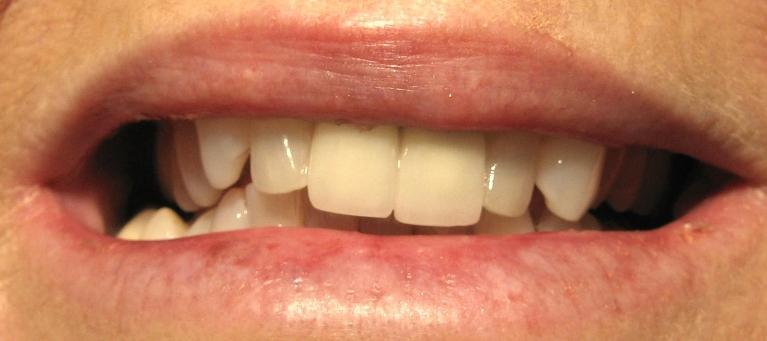 Metal-Free-Crowns-Porcelain-Veneers-Before-Image