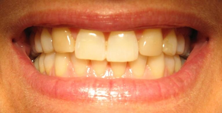 In-Office-Teeth-Whitening-Porcelain-Veneers-Before-Image