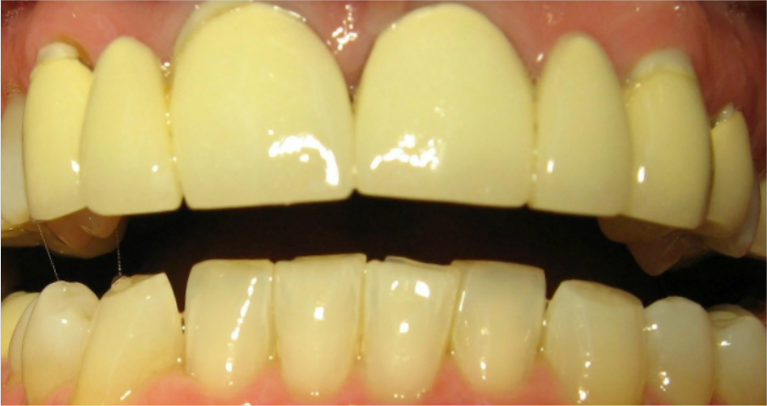 Metal-Free-Bridges-Before-Image