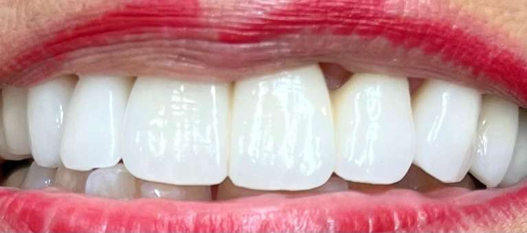 Porcelain-and-Zirconia-Crowns-and-Bridges-After-Image