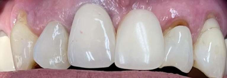 Porcelain-and-Zirconia-Crowns-and-Bridges-Before-Image